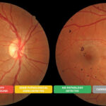 KI-basiertes Augenscreening für OCT-Geräte